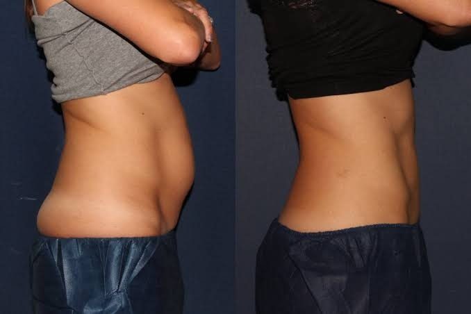 Abdominal & Flank Fat Freezing Transformation Result