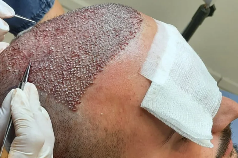 High-density micro-follicular graft implantation