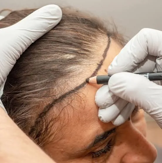 Pre-procedure surgical hairline marking and facial symmetry analysis at Kezza Clinic