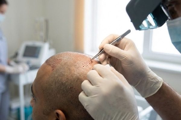 Implantation of follicular units into recipient channels at Kezza Clinic, Jaipur