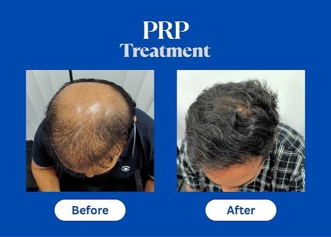 Before and after clinical results of PRP therapy: visible scalp thinning restored to thick terminal density
