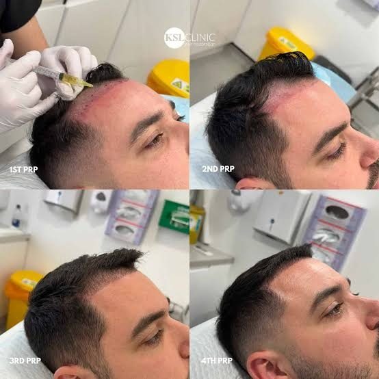 Clinical stages of PRP hair restoration: 1st PRP, 2nd PRP, 3rd PRP, 4th PRP progression