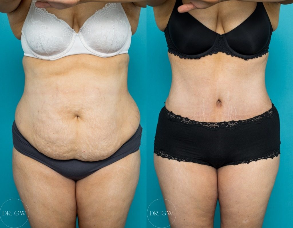 Post-Pregnancy Tummy Tightening & Smoothing Result